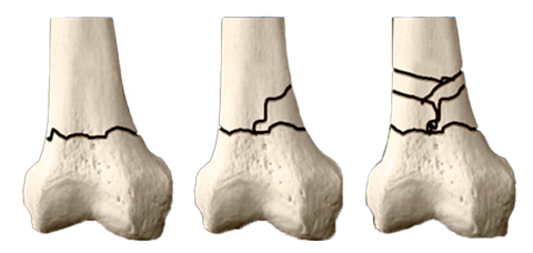 Esquema de tres huesos con Fracturas supracondilea (extra articular)