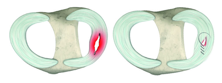 Esquema lesión de meniscos
