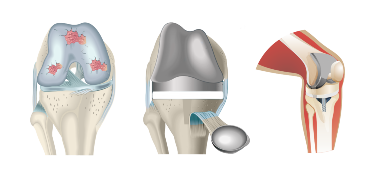 Tres esquemas de artrosis de rodilla