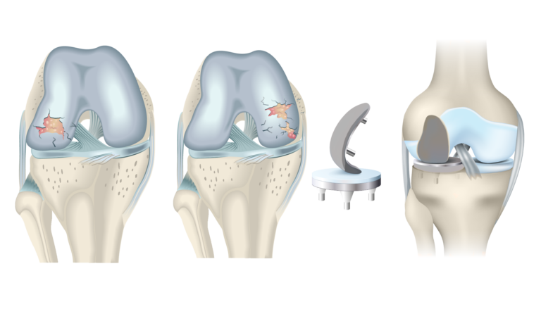 Esquema Protesis patelo