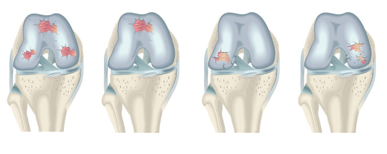 Infografía de cuatro rodillas con diferentes lesiones