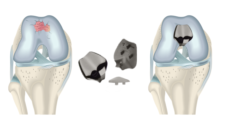 Esquemas de ROTULA Y TROCLEA