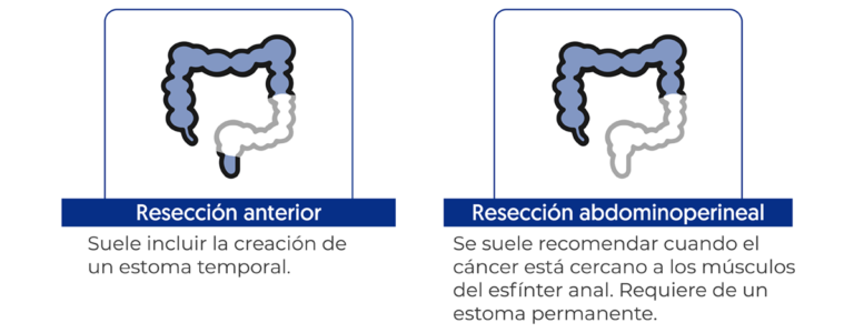Resección anterior, resección abdóminoperineal