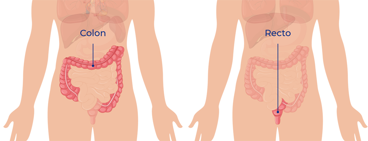 ¿Qué es el cáncer de cólon?