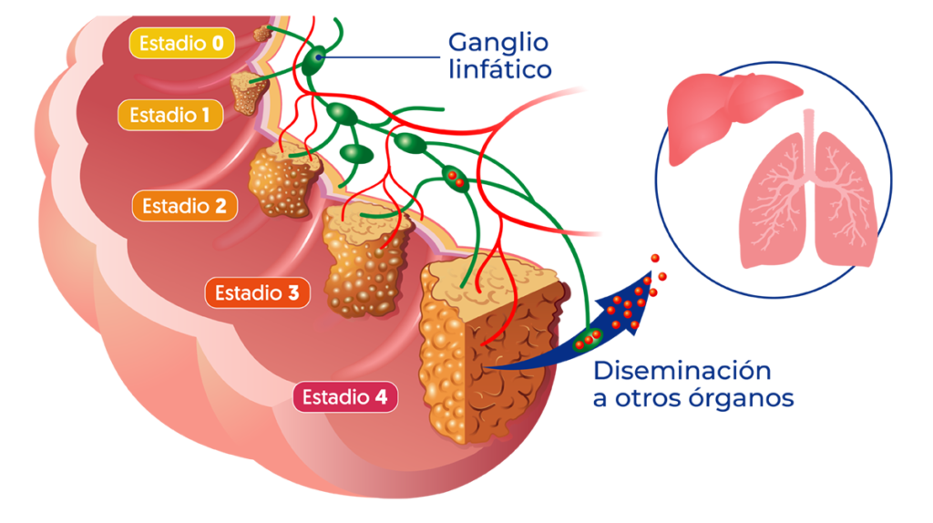 progresión del cáncer de cólon