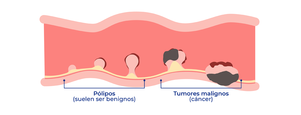 Tipos de Pólipos