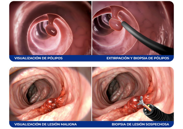 Exámenes visuales, colonoscopía