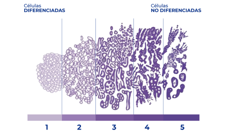 Estadío de la células en la escala de Gleason