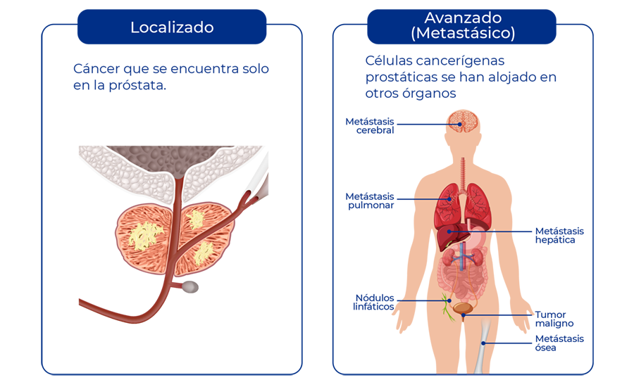 Estadío del cáncer, localizado, avanzado, metastásico o diseminado