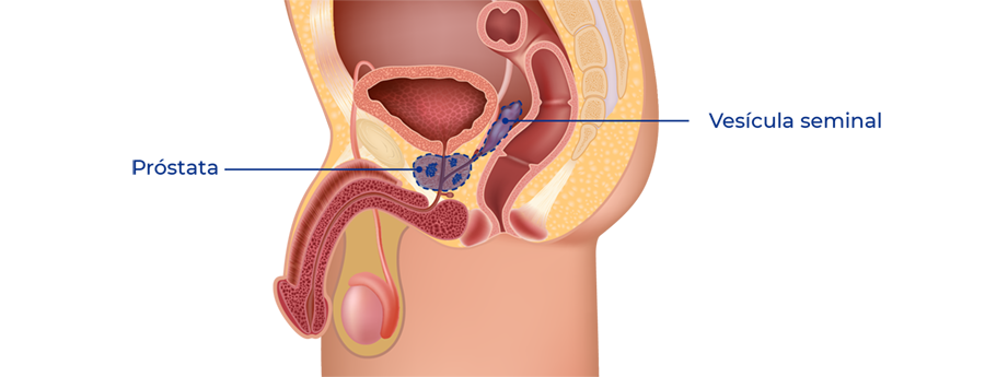 Tratamiento quirúrgico de la próstata