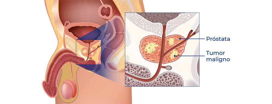 Anátomo patología del tumor de próstata