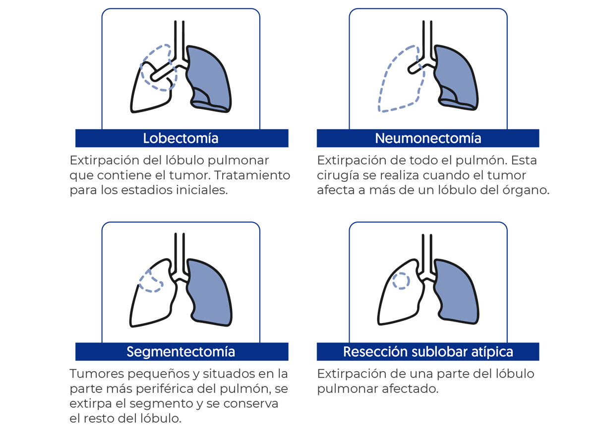 Lobectomía extirpación del un lúbulo pulmonar, Neumonectomía extirpación de todo un pulmón derecho o izquierdo, Segmentectom extirpación de un segmegto pequeño localizado, resección sublobar atípica extirpación de la parte lobular afectada.