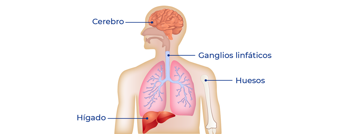 Metástasis del cáncer de pulmón, cerebro, hígado, hueso, ganglios linfáticos