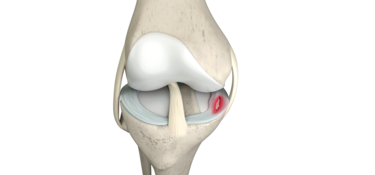 Esquema rodilla lesionada