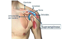 Bursitis subacromial – Tendinosis manguito rotador