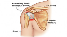 Capsulitis adhesiva