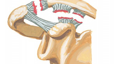 Disyunción acromioclavicular