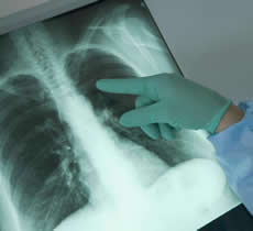 Enfermedades pulmonares intersticiales