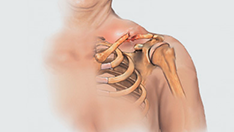Fractura de Clavícula
