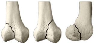 Tres huesos con fractura de cóndilo