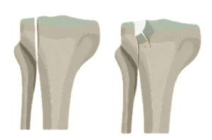 Esquema de dos huesos con fractura de platillos tibiales