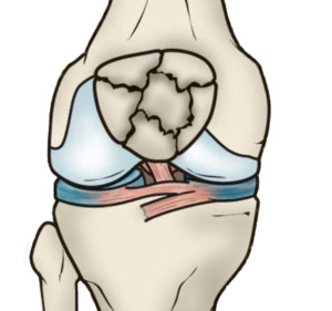 Dibujo de rótula fracturada
