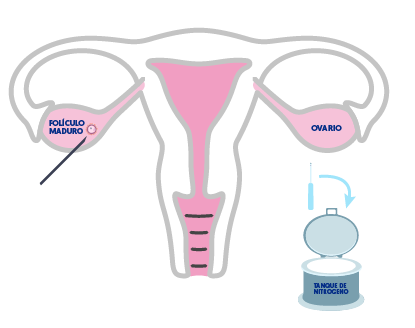 Criopreservación de ovocitos