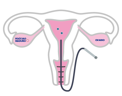 Fecundación In Vitro