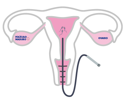 Inseminzación Artificial