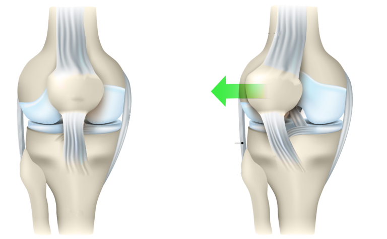 Esquema rodillas con inestabilidad y dolor rotuliano