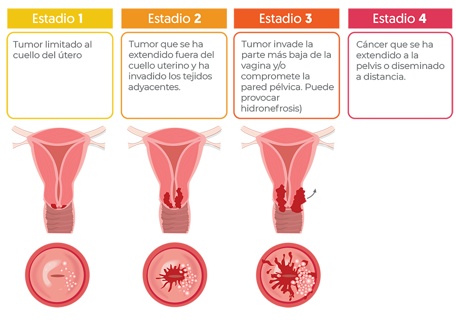Etapificación del Cáncer