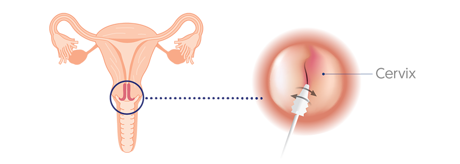 Evaluación ginecológica, (PAP) papanicolau 