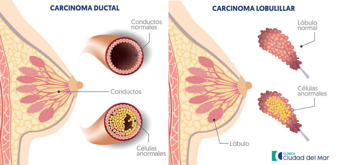 Tipos de cáncer de mama, carcinoma ductal, carcinoma lobulillar