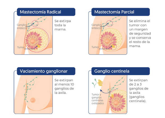 Cirugía mamaria, mastectomía radical, mastectomía parcial, vaciamiento ganglionar, ganglio centinela