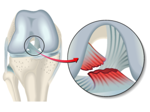 Esquema rotura de ligamento