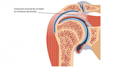 Tendinitis calcificante