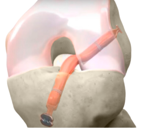 Esquema injerto de ligamento