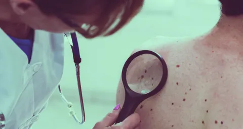 lunares, ¿Cuándo consultar a un Especialista? cancer de piel