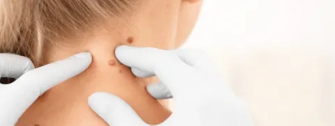 Cuello de mujer con lunares.