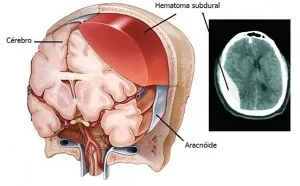 Hematoma subdural crónico