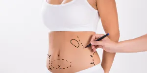¿Cuándo hacerse una abdominoplastía?