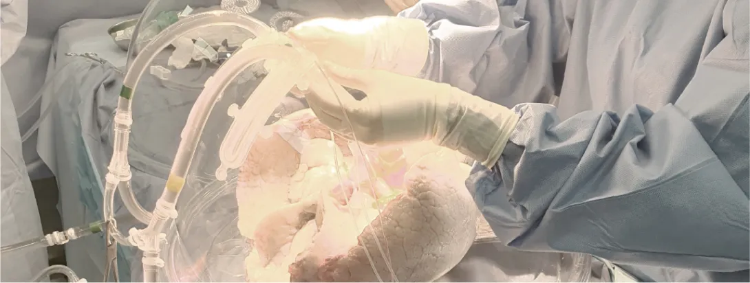 Trasplante de médula ósea