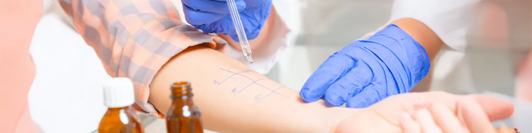 Brazo de paciente realizando test de alergia