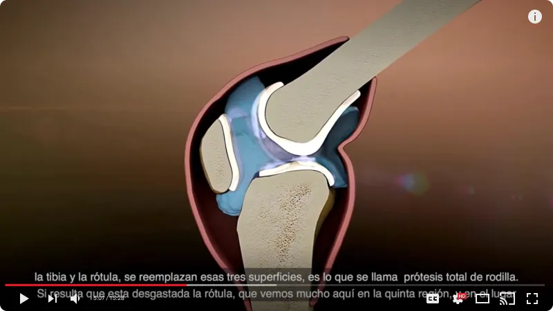 Captura de YouTube video Artrosis de rodilla_ ¿Para qué sirven las prótesis_