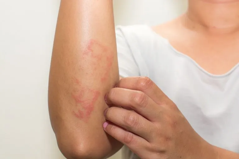 Dermatitis Atópica: Causas y tratamientos