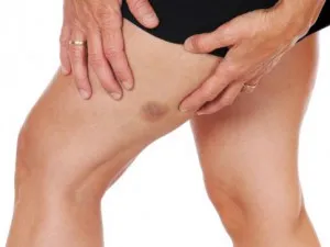 Moretones: ¿Cuándo preocuparse?