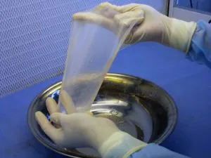 60 Madres gestantes de CCdM donarán sus membranas amnióticas para estudio de quemaduras pediátricas