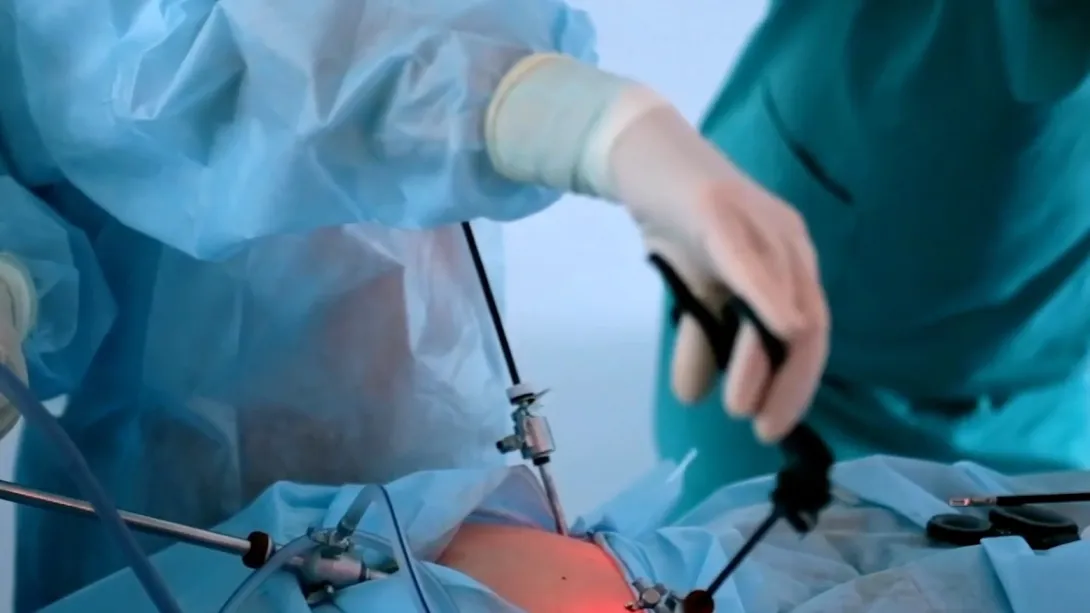 Colecistectomía laparoscópica: Una solución para los cálculos en la vesícula biliar