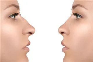 Rinoplastia de preservación dorsal: una revolución en cirugías estéticas de nariz