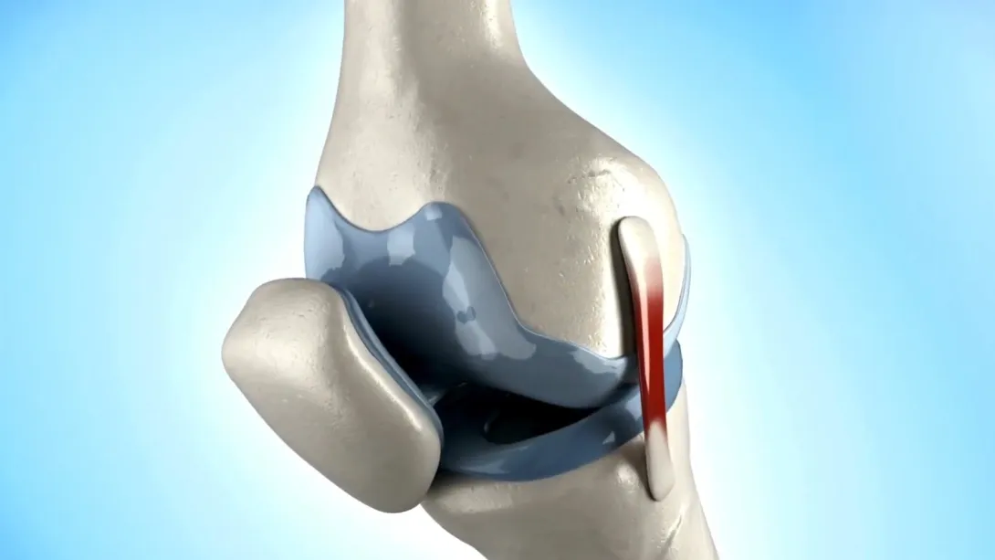 Desgaste de cartílago de rodilla: Descubre los síntomas y tratamientos